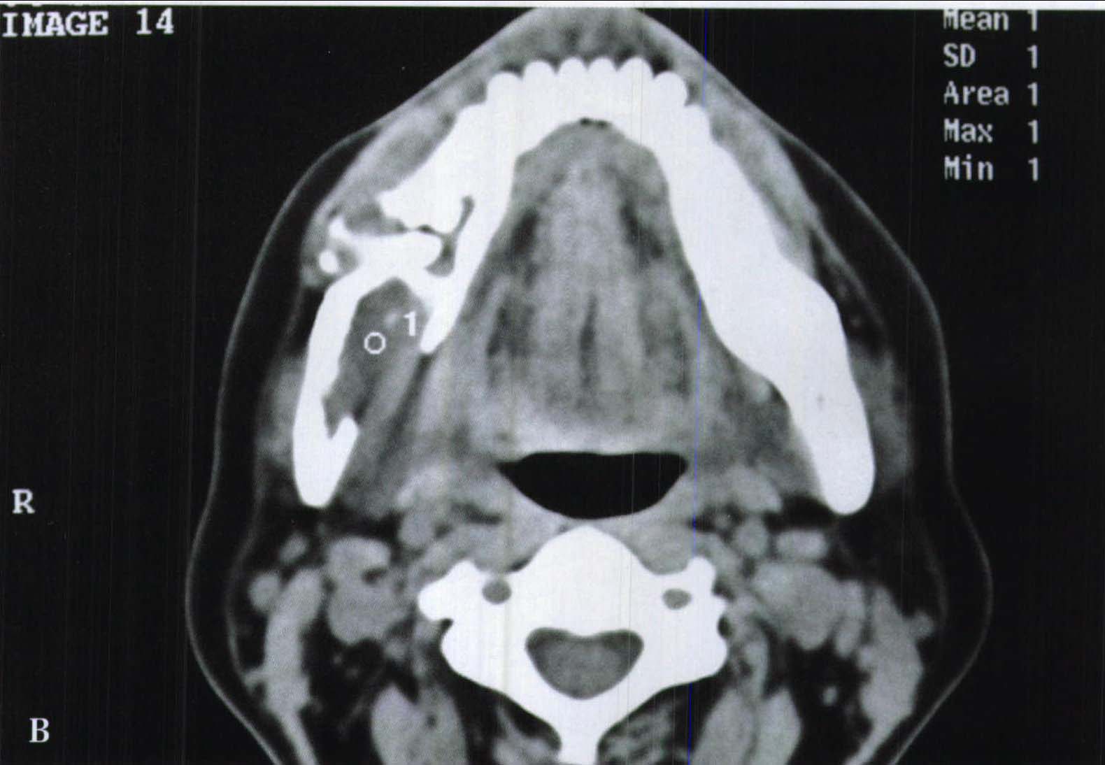 牙瘤19例CBCT影像学分析
